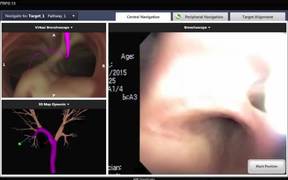 ENB With GenCut Core Biopsy System - Tech - VIDEOTIME.COM